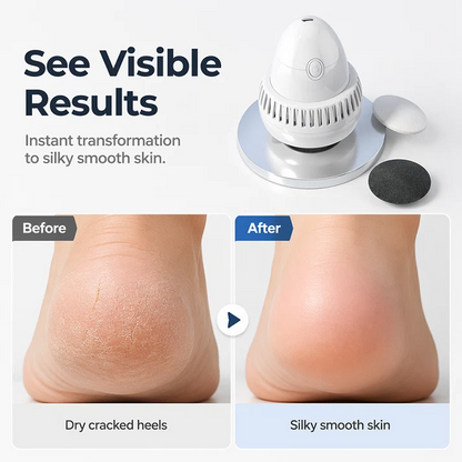 Rechargeable Electric Foot Scraper – 2-Speed Callus Remover with Vacuum